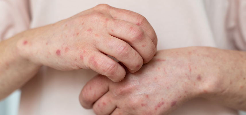 Alerta de brote de sarampión en Australia: Estrategias cruciales para proteger tu salud y la de tu familia | Universidad del Rosario