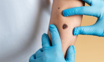 Melanoma: el tipo de cáncer de piel con mayor mortalidad en las personas