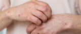 Alerta de brote de sarampión en Australia